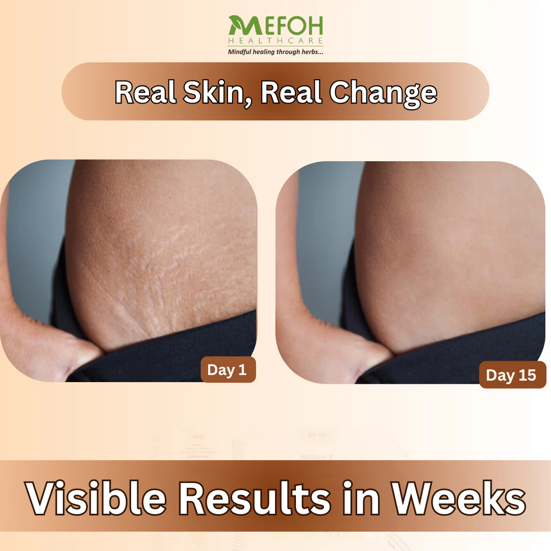 Anti-Stretch Marks Oil – Nourishing & Repairing Oil for Smoother, Firmer Skin