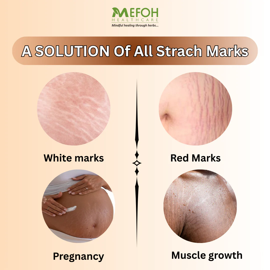 Anti-Stretch Marks Oil – Nourishing & Repairing Oil for Smoother, Firmer Skin